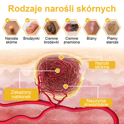 ✨🎁Krem FROPUN do usuwania pieprzyków i znamion (ostatni dzień promocji 85% taniej)