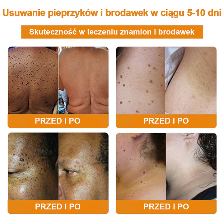 【🌊 Za pobraniem🌊 】 Vsoxa™ Krem do usuwania brodawek i pieprzyków z jadem pszczelim (👨‍⚕Zalecenia AAD) 🐝🐝 (🔥Ostatni dzień wyprzedaży 70% taniej)