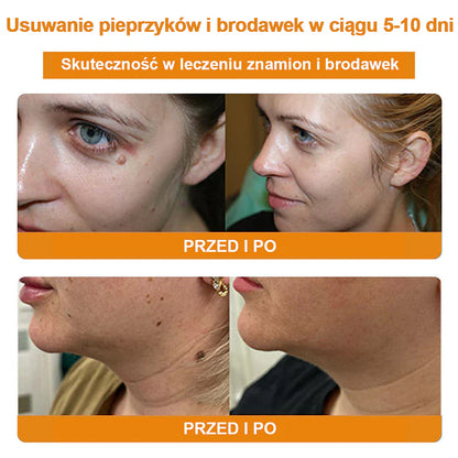 【🌊 Za pobraniem🌊 】 Vsoxa™ Krem do usuwania brodawek i pieprzyków z jadem pszczelim (👨‍⚕Zalecenia AAD) 🐝🐝 (🔥Ostatni dzień wyprzedaży 70% taniej)