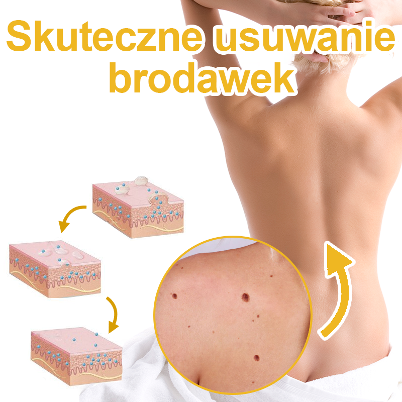 ✨🎁Krem FROPUN do usuwania pieprzyków i znamion (ostatni dzień promocji 85% taniej)