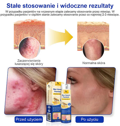 (🔥Płatność przy odbiorze🔥60% zniżki) LOVILDS™ PsoriaHeal Spray na łuszczycę (wysyłka na cały świat – bezpłatna wysyłka)🌐