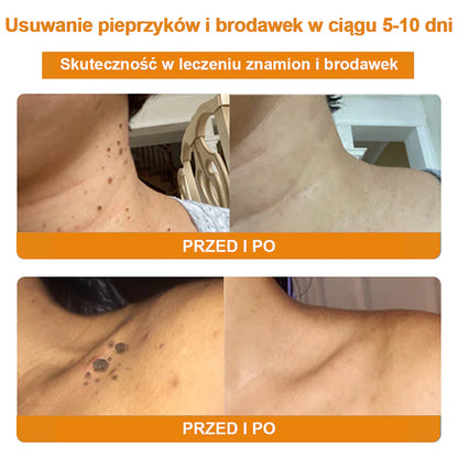 【🌊 Za pobraniem🌊 】 Vsoxa™ Krem do usuwania brodawek i pieprzyków z jadem pszczelim (👨‍⚕Zalecenia AAD) 🐝🐝 (🔥Ostatni dzień wyprzedaży 70% taniej)