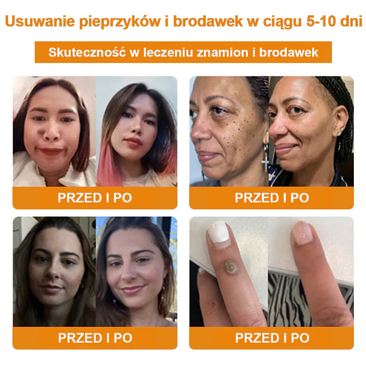 【🌊 Za pobraniem🌊 】 Vsoxa™ Krem do usuwania brodawek i pieprzyków z jadem pszczelim (👨‍⚕Zalecenia AAD) 🐝🐝 (🔥Ostatni dzień wyprzedaży 70% taniej)