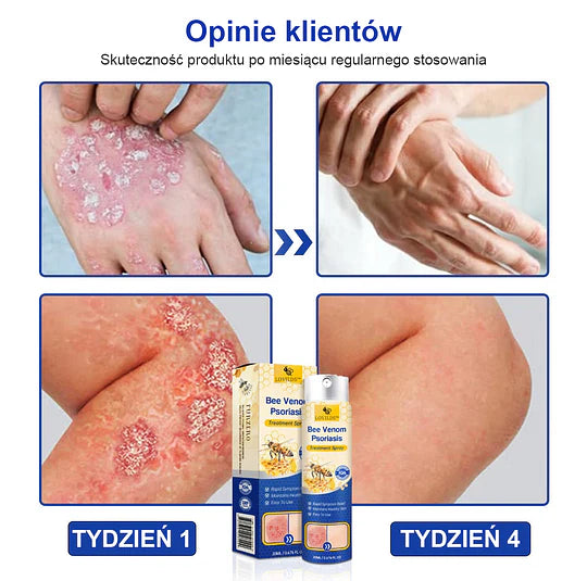 (🔥Płatność przy odbiorze🔥60% zniżki) LOVILDS™ PsoriaHeal Spray na łuszczycę (wysyłka na cały świat – bezpłatna wysyłka)🌐