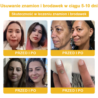 ✨🎁Krem FROPUN do usuwania pieprzyków i znamion (ostatni dzień promocji 85% taniej)