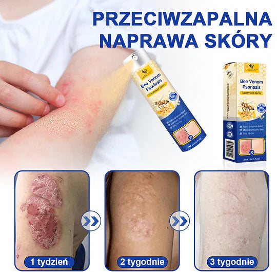 (🔥Płatność przy odbiorze🔥60% zniżki) LOVILDS™ PsoriaHeal Spray na łuszczycę (wysyłka na cały świat – bezpłatna wysyłka)🌐