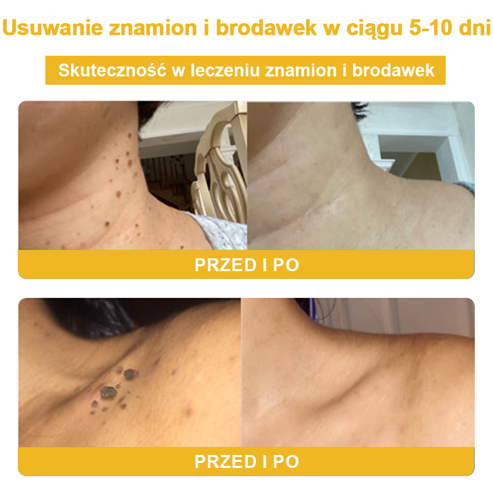 ✨🎁Krem FROPUN do usuwania pieprzyków i znamion (ostatni dzień promocji 85% taniej)