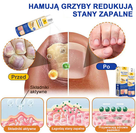 (🔥Płatność przy odbiorze🔥60% zniżki) LOVILDS™ PsoriaHeal Spray na łuszczycę (wysyłka na cały świat – bezpłatna wysyłka)🌐